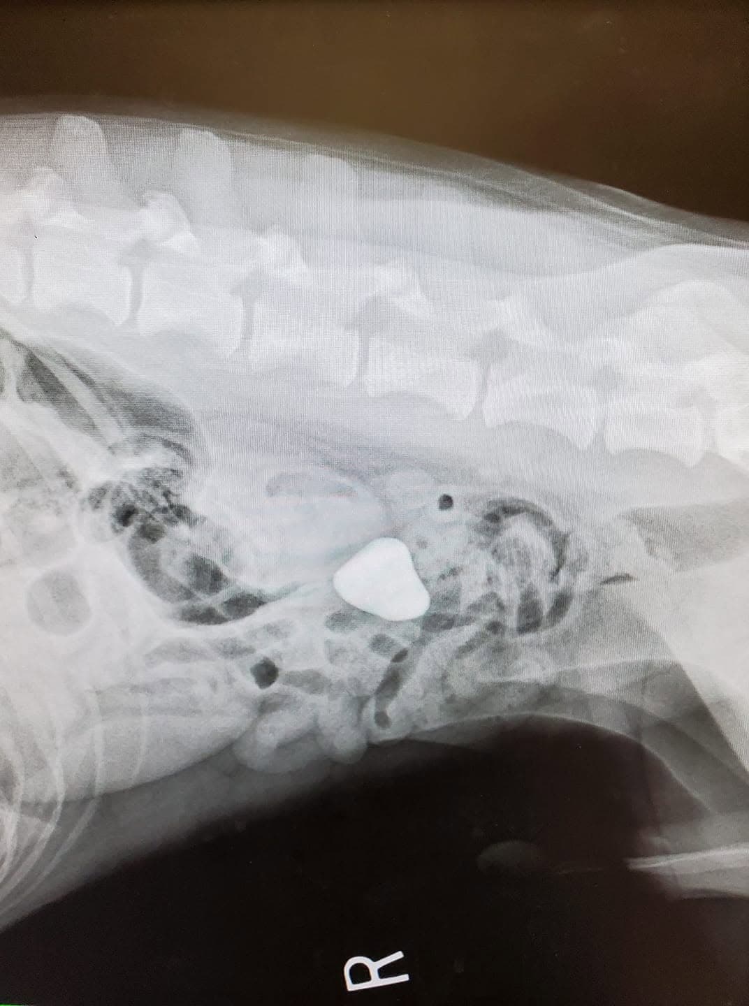 Abdominal film with a bright spot that shouldn't be there